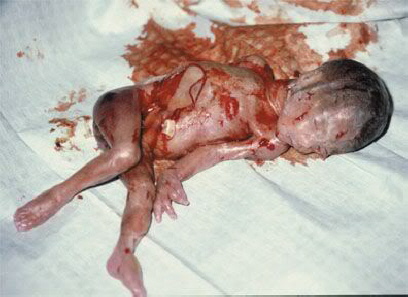 Mord in der 22. Woche der Schwangerschaft